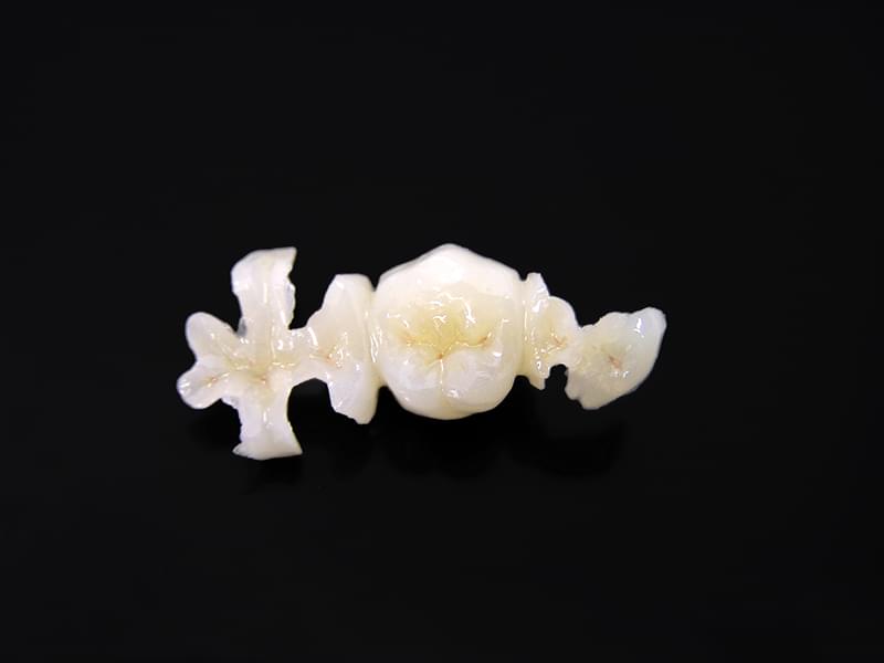 セラミックインレー