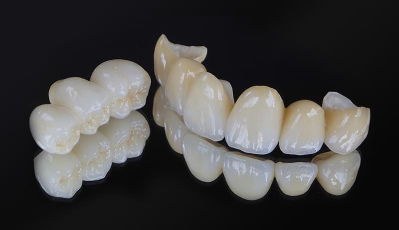 セラミッククラウン