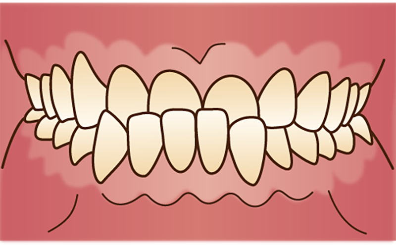 受け口（下顎前突・上顎劣成長）